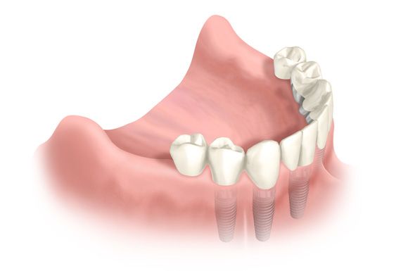 Feste Implantatgetragene Brücke Im Zahnlosen Unterkiefer